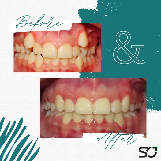 Before and after orthodontic treatment at Smileon Dental Center