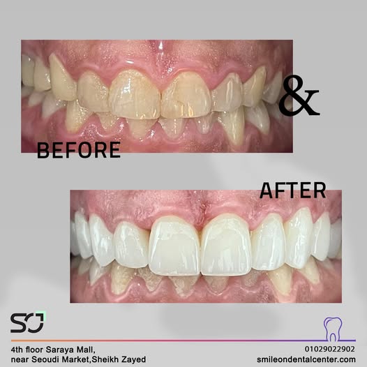 Before and after Hollywood Smile veneers at Smileon Dental Center