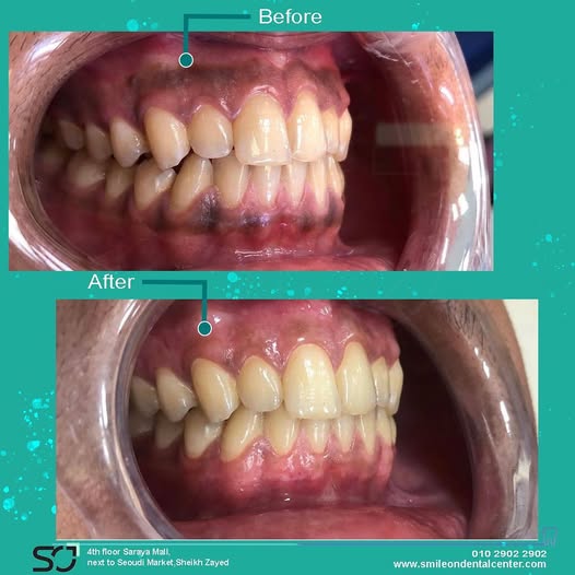 Before and after teeth alignment case at Smileon Dental Center